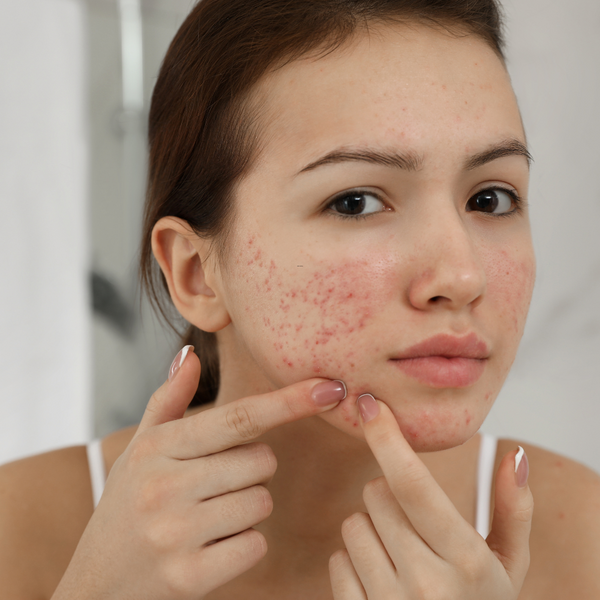 Best acne-prone skincare for pimples in Pakistan | B&B Derma