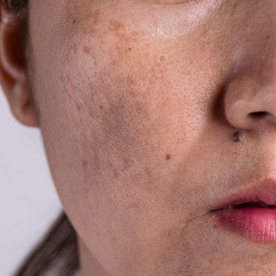 Best hyperpigmentation treatment for dark spots and skin repair in Pakistan | B&B Derma