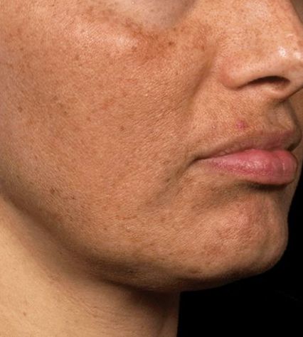 Best skin brightening treatment for dull skin tone in Pakistan | B&B Derma