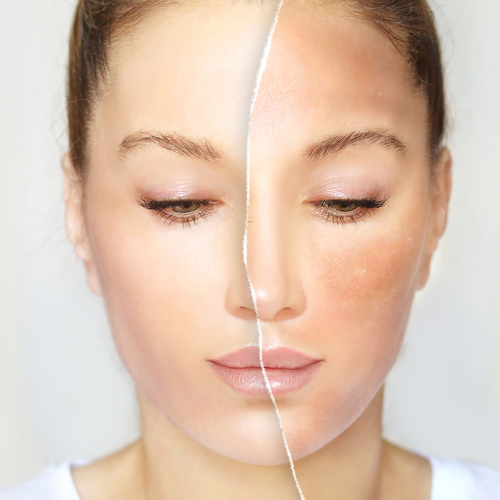 Glowing skin brightening treatment By BNB Derma