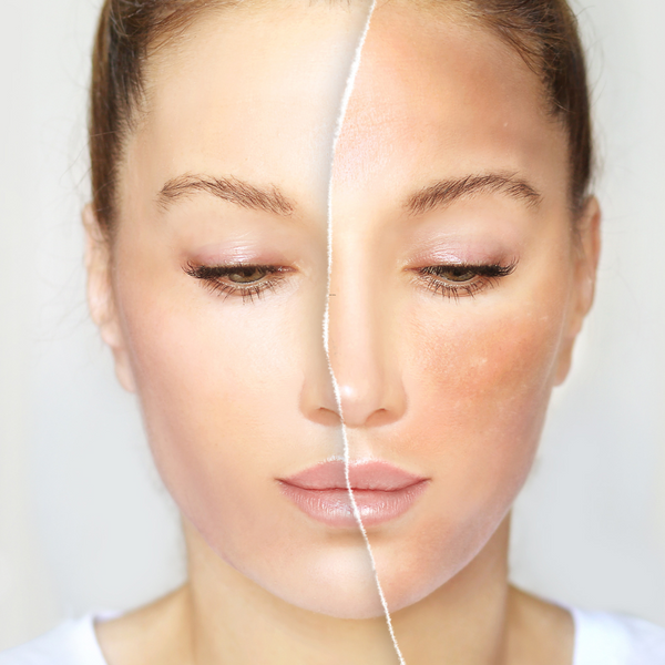 Glowing skin brightening treatment By BNB Derma