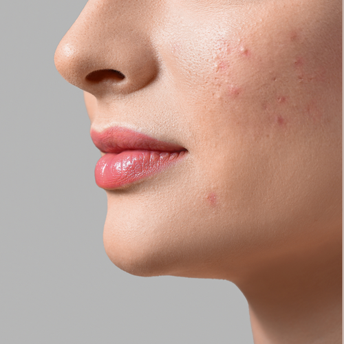 Skincare for oily skin and pores - By BNB Derma 